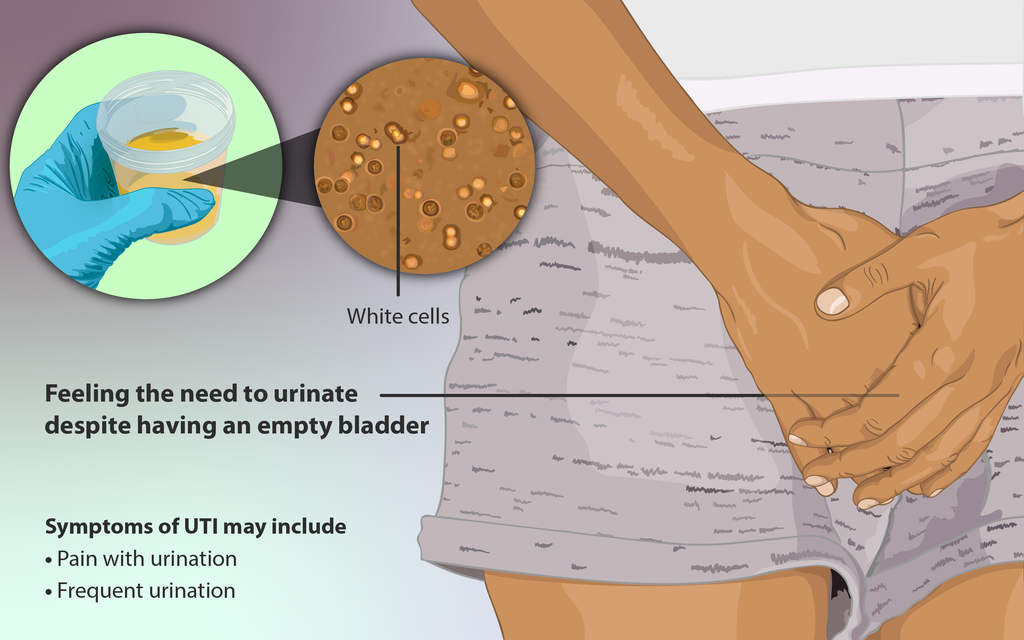 Medical illustration depicting acute urinary frequency, dysuria, and bladder urgency