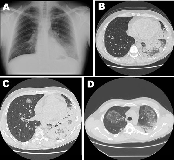 Community-Acquired Pneumonia clinical reference photography